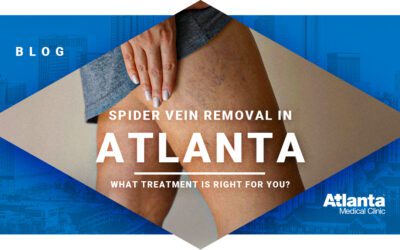 Spider Vein Removal in Atlanta
